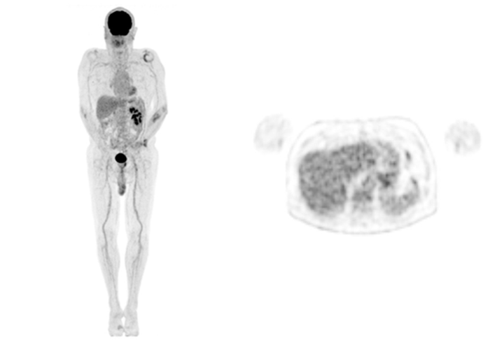 Whole body maximum intensity projection and axial image of a patient